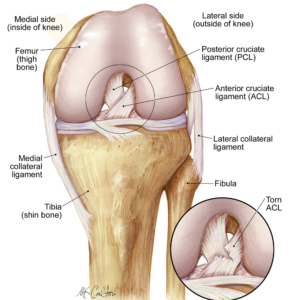 Cedera ACL 1