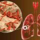 TBC atau tuberculosis disebabkan oleh bakteri mycobacterium tuberculosis yang menyerang organ paru
