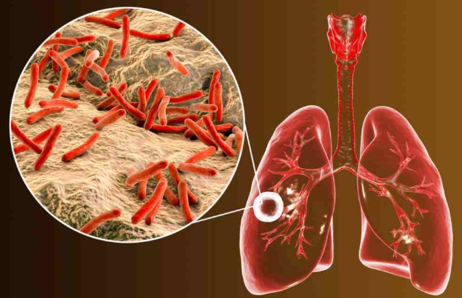 TBC atau tuberculosis disebabkan oleh bakteri mycobacterium tuberculosis yang menyerang organ paru