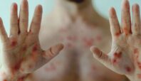 Pencegahan Penularan Virus Mpox, Dinkes Kabupaten Tangerang Terbitkan Surat Edaran