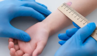 Mantoux Test untuk Mencegah TBC Sejak Dini