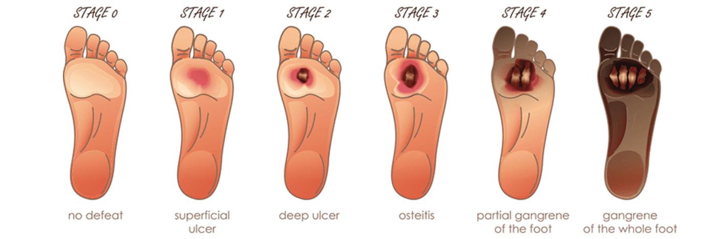 Waspada Kaki Diabetes! Gejala, Penyebab Luka, dan Cara Merawat Luka agar Tak Berujung Amputasi 2 Screenshot 2025 11 06 122640