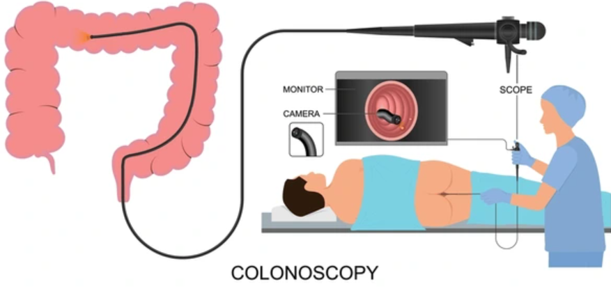 Apa Itu Kolonoskopi? Rencana Lula Lahfah Lakukan Pemeriksaan Kolonoskopi Sebelum Meninggal 2 Pemeriksaan Kolonoskopi