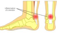 Cedera Tendon Achilles