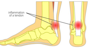 Cedera Tendon Achilles