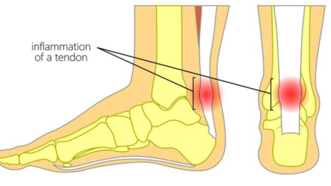 Cedera Tendon Achilles